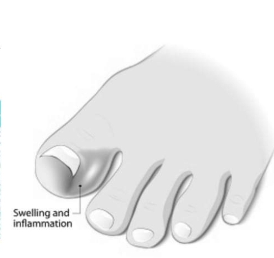 toe cap (2)