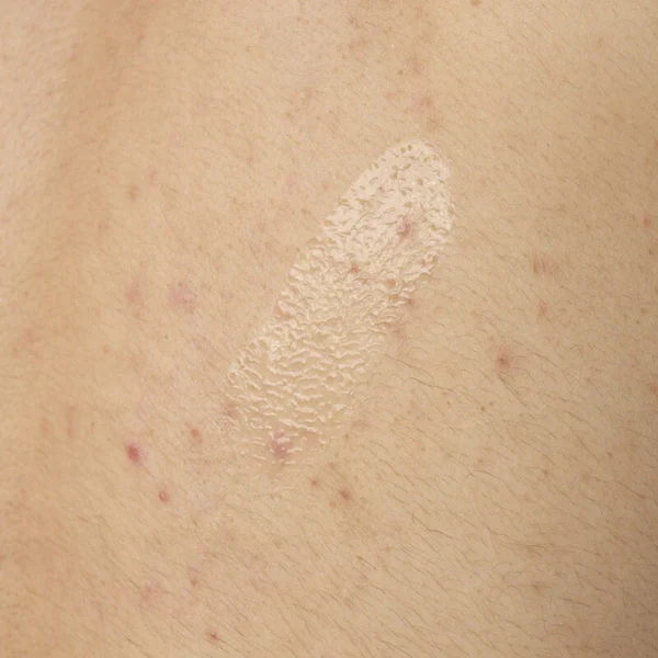 TheOrdinarySalicylicAcid0.5_BodySerumExfoliatingTreatmentForAcne